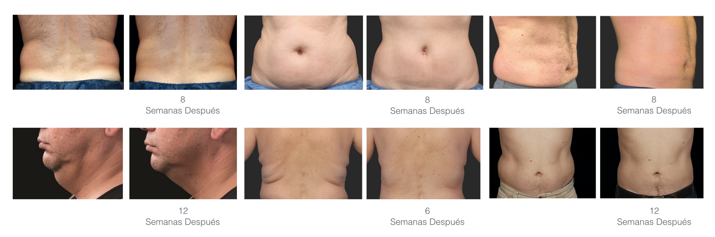 CoolSculpting / Criolipolisis