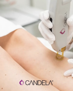 depilacion candela caba